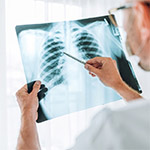 New gene target for aggressive lung cancer discovered